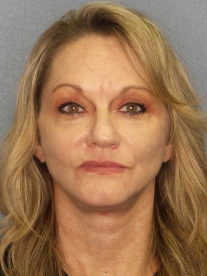 Facelift Before & After Patient #11903