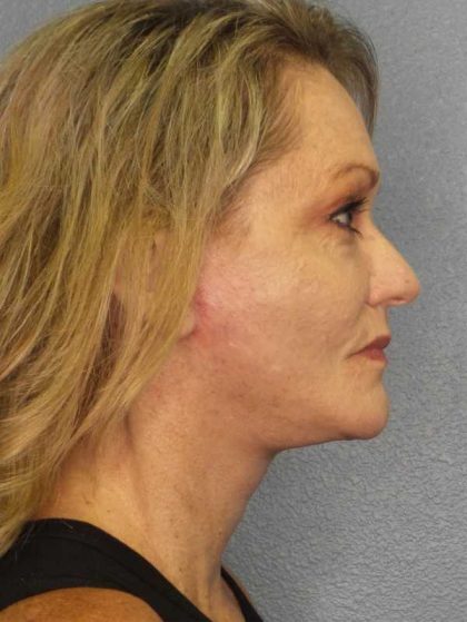 Facelift Before & After Patient #11903