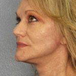 Facelift Before & After Patient #11903