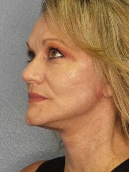 Facelift Before & After Patient #11903