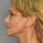 Facelift Before & After Patient #11903