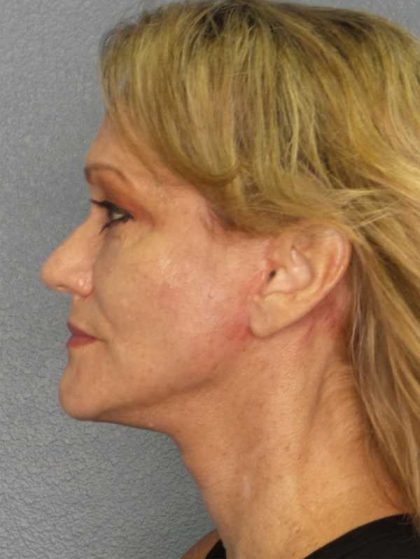 Facelift Before & After Patient #11903