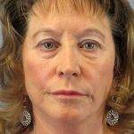 Facelift Before & After Patient #11694