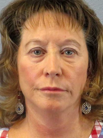 Facelift Before & After Patient #11694