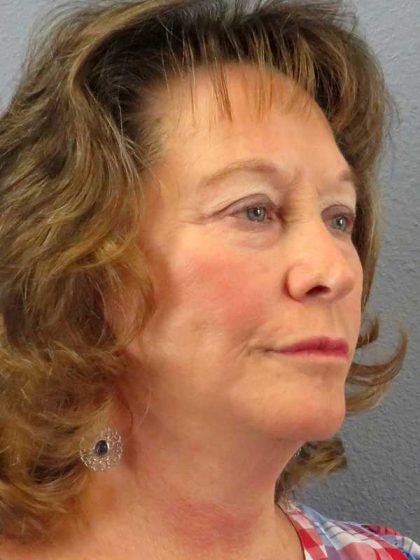 Facelift Before & After Patient #11694