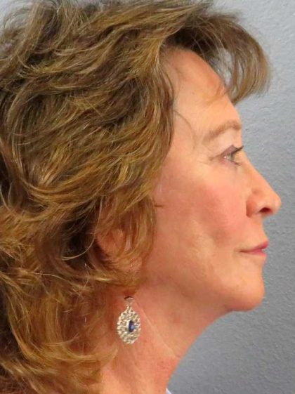Facelift Before & After Patient #11694