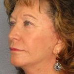 Facelift Before & After Patient #11694