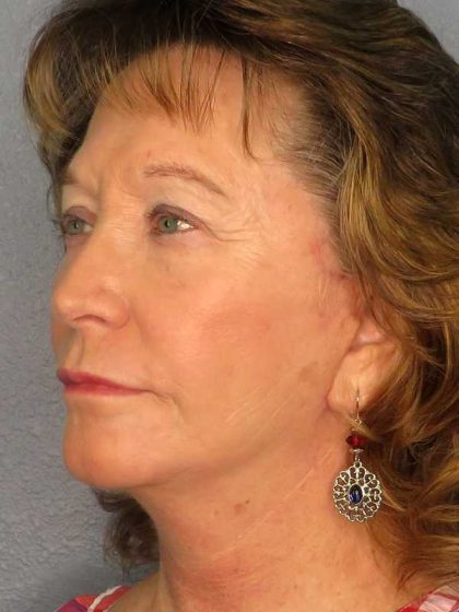 Facelift Before & After Patient #11694