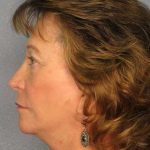 Facelift Before & After Patient #11694