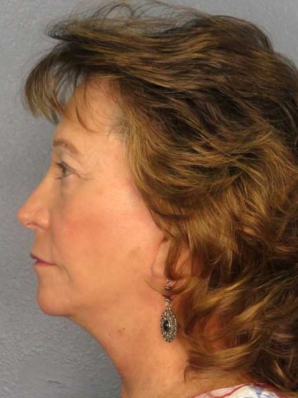 Facelift Before & After Patient #11694