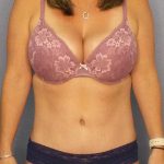 Abdominoplasty Before & After Patient #11086