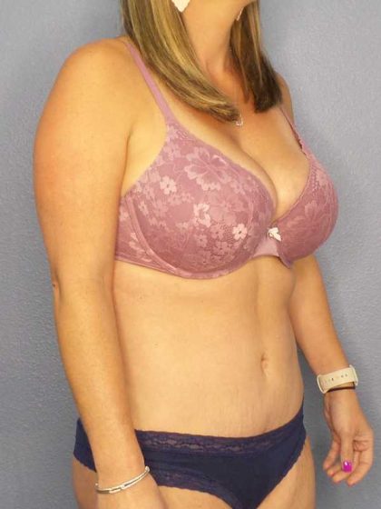 Abdominoplasty Before & After Patient #11086
