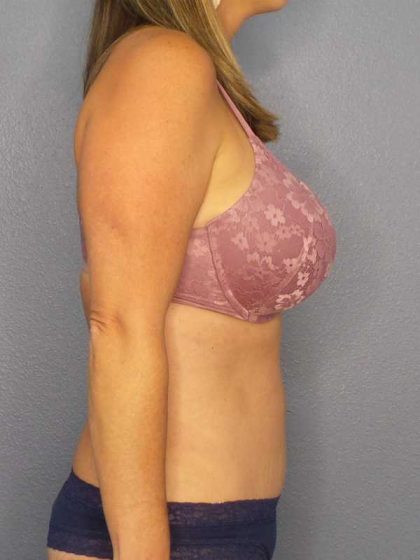 Abdominoplasty Before & After Patient #11086