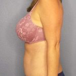 Abdominoplasty Before & After Patient #11086