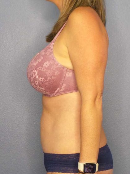 Abdominoplasty Before & After Patient #11086