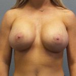 Breast Augmentation Before & After Patient #11414