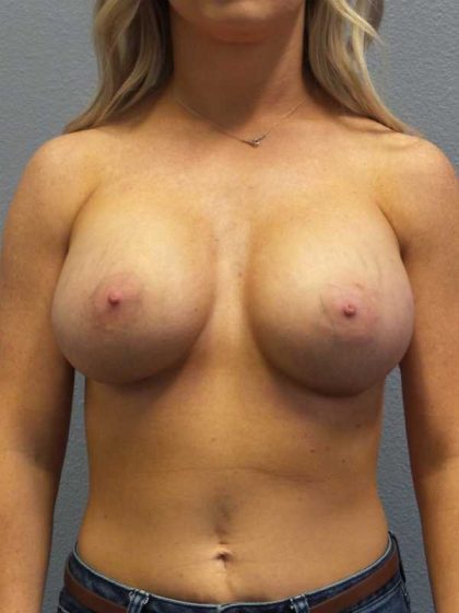Breast Augmentation Before & After Patient #11414