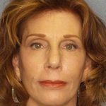Facelift Before & After Patient #11725