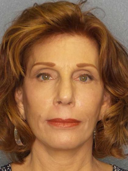 Facelift Before & After Patient #11725
