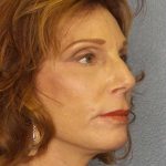 Facelift Before & After Patient #11725