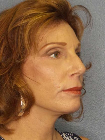 Facelift Before & After Patient #11725