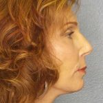Facelift Before & After Patient #11725