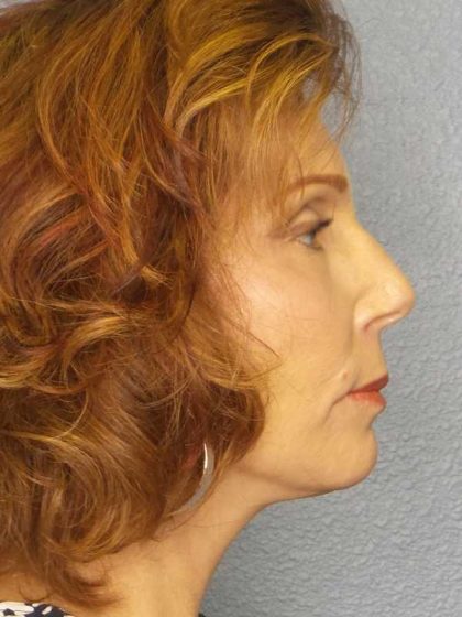 Facelift Before & After Patient #11725