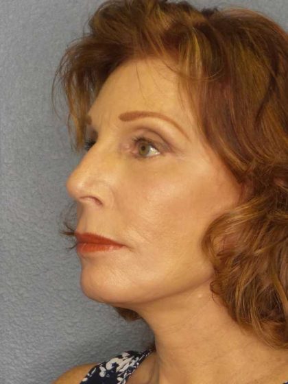 Facelift Before & After Patient #11725