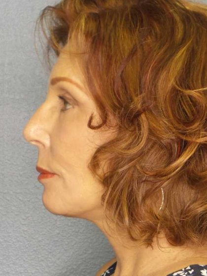 Facelift Before & After Patient #11725