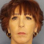 Facelift Before & After Patient #11714