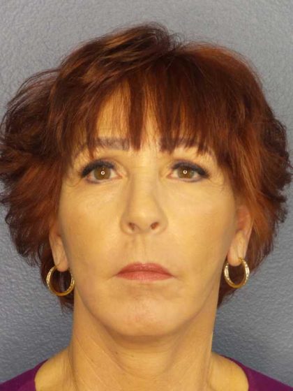 Facelift Before & After Patient #11714