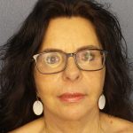 Facelift Before & After Patient #7514