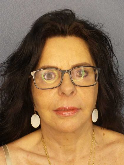 Facelift Before & After Patient #7514