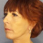 Facelift Before & After Patient #11714