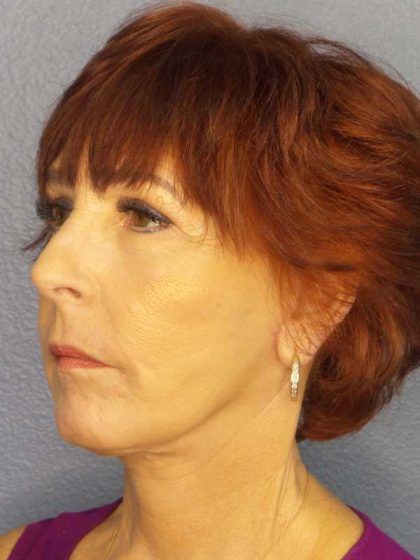 Facelift Before & After Patient #11714