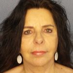 Facelift Before & After Patient #7514
