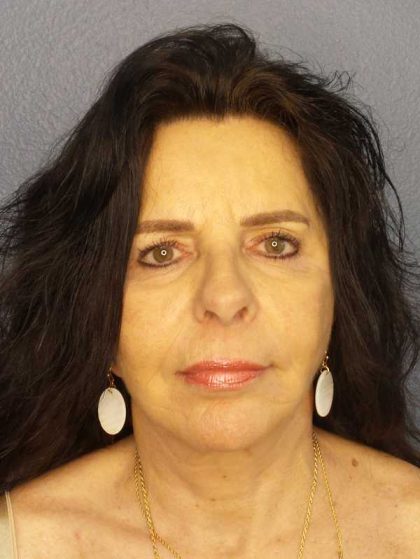 Facelift Before & After Patient #7514