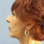 Facelift Before & After Patient #11714