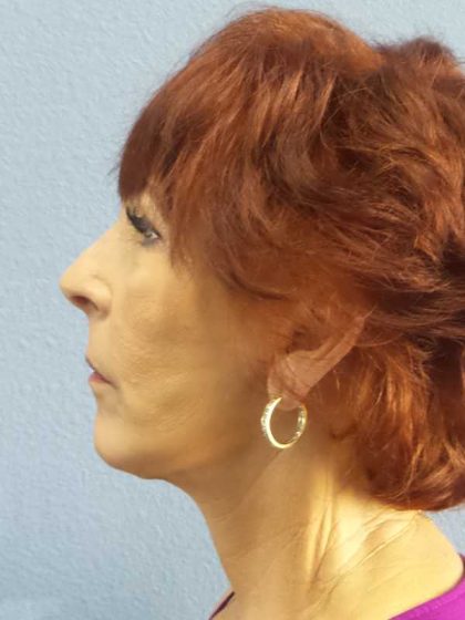 Facelift Before & After Patient #11714