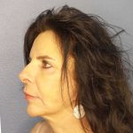 Facelift Before & After Patient #7514