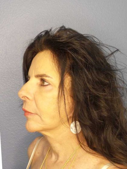Facelift Before & After Patient #7514