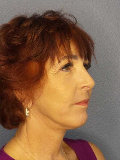 Facelift Before & After Patient #11714