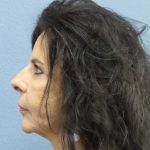 Facelift Before & After Patient #7514
