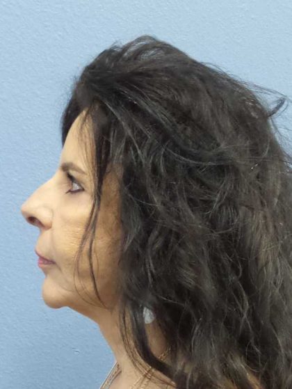 Facelift Before & After Patient #7514
