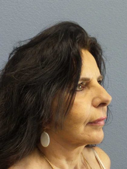 Facelift Before & After Patient #7514