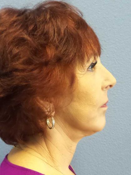 Facelift Before & After Patient #11714