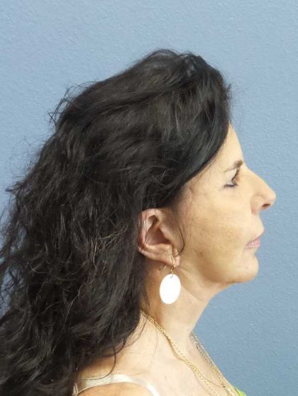 Facelift Before & After Patient #7514