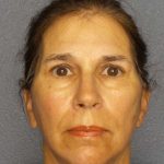 Facelift Before & After Patient #7557