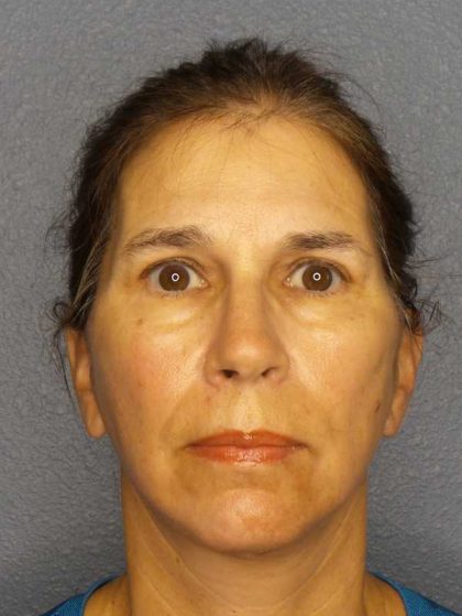 Facelift Before & After Patient #7557