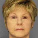 Facelift Before & After Patient #11640